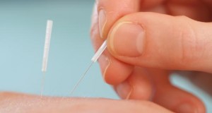 Alternative Methode bei Heuschnupfen: Akupunktur