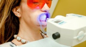 Bleaching der Zähne