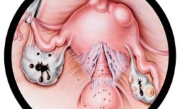 Endometriose - Abnormale Wucherung der Gebärmutterschleimhaut (Detailbild)
