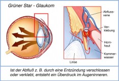 EIn Schaubild das Glaukom (Grüner Star) darstellt.