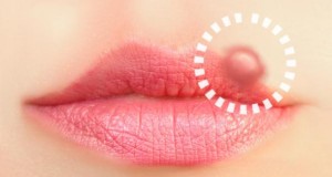 Herpesviren: Lippenherpes an der Oberlippe einer Frau.