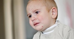 Kinderkrankheit Windpocken - kleiner Junge hat Hautausschlag.