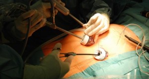 Ein Magenband wird von einem Chirurgen eingesetzt.