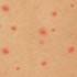 Mallorca Akne - juckender Hautausschlag mit Pusteln und Quaddeln auf der Haut