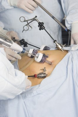Mikrovasiver Eingriff: der Magenbypass führt zu einer Magenverkleinerung