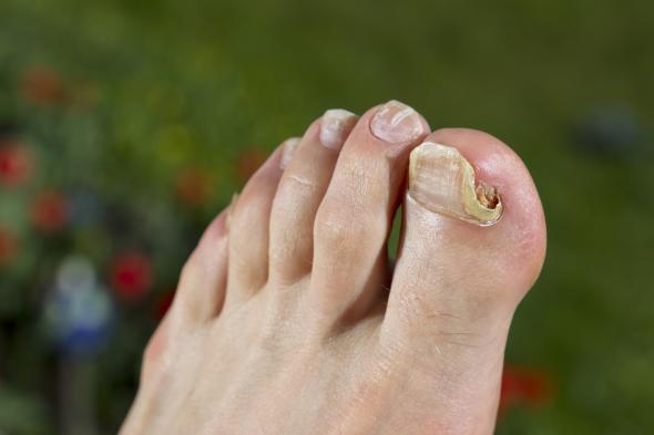 Onychomykose - Der Fußnagel ist vom Nagelpilz befallen.