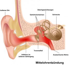 Schaubild: Mittelohrenentzündung (Otitis media)