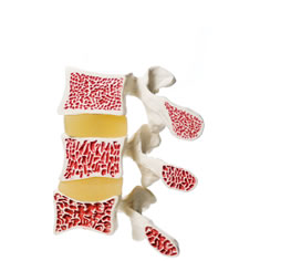 Künstliches Modell der Stadien von Osteoporose