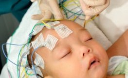 Dravet-Syndrom: Gehirnströme des Säuglings werden per EEG gemessen
