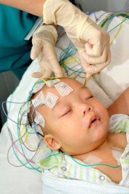 Dravet-Syndrom: Gehirnströme des Säuglings werden per EEG gemessen