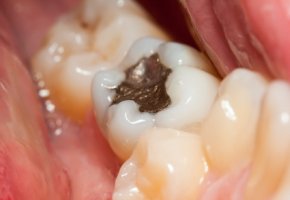 Zahnfüllung mit dem giftigen Amalgam