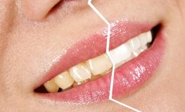 Zahnverfärbungen Vorbeugen